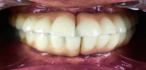Full Mouth Rehabilitation with 12 Implants and 24 Units of Bridges - After
