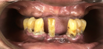 Full Mouth Rehabilitation with 12 Implants and 24 Units of Bridges - Before