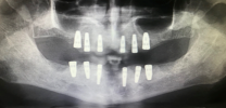 Full Mouth Rehabilitation with 12 Implants and 24 Units of Bridges - Xray