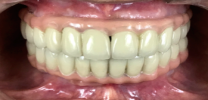 Full Mouth Rehabilitation with Dental Implants - After