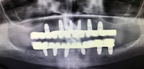 Full Mouth Rehabilitation with Dental Implants - Xray