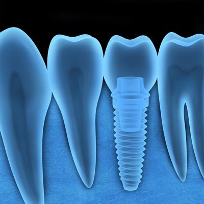 MISSING TEETH REPLACED WITH DENTAL IMPLANTS