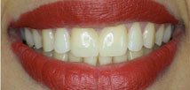 Gap Closure with Metal Free Crowns - After