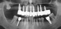 Full Upper Arch Restored With 8 Dental Implants in Delhi