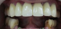 Multiple Lower Front Teeth Restored With 3 Dental Implants in Delhi