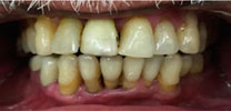 Restored Front Lower Tooth Replaced With Dental Implant in Delhi