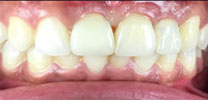 Multiple Missing Front Teeth Restored With Dental Implants in Delhi