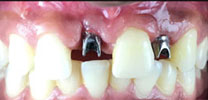 Multiple Missing Front Teeth Restored With Dental Implants in Delhi