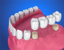 dental crowns - dental bridges near me