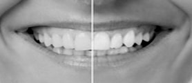 ZOOM Teeth Whitening